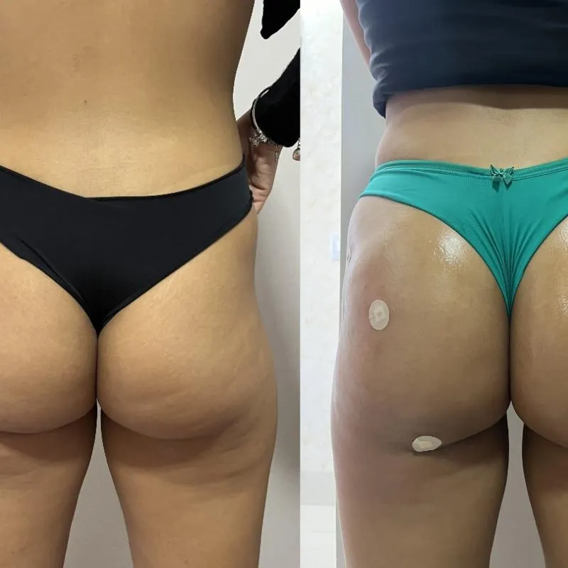 Imagem da campanha 3 sessões de Bumbum na nuca