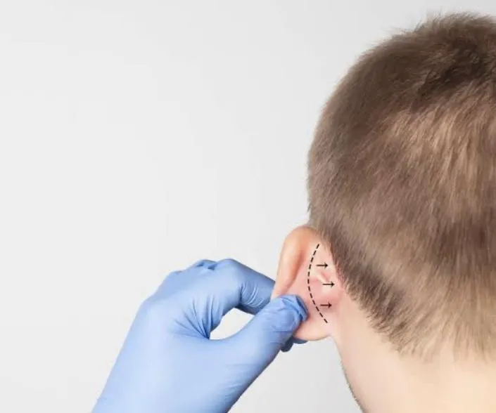 Imagem da campanha Otoplastia