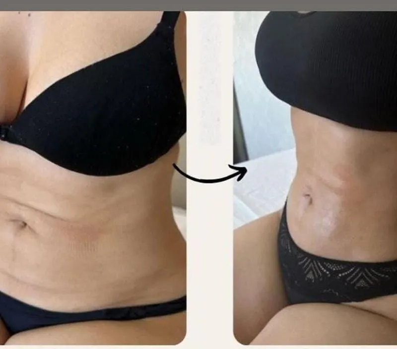 Imagem da campanha Criolipólise+Endolaser+ pós