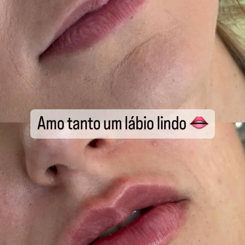 Imagem da campanha Preenchimento Labial