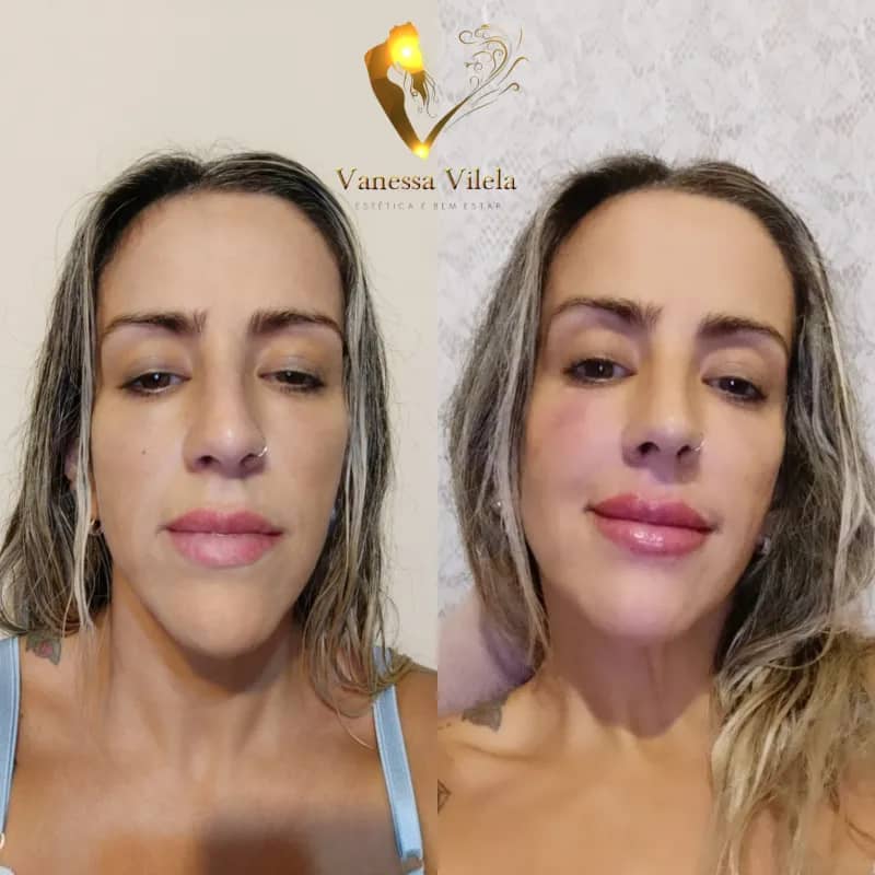 Imagem da campanha Escultura Labial 1 ml Rennova