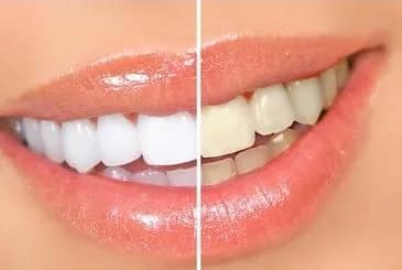 Imagem da campanha Rifa de clareamento dental