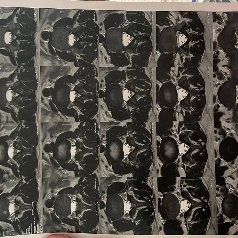 Imagem da campanha Cirurgia Hérnia de disco