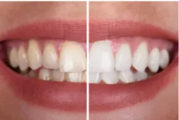 Imagem da campanha Limpeza e um Clareamento Dental