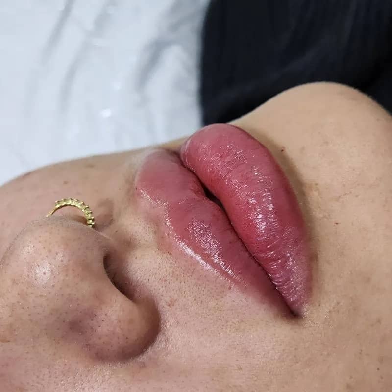 Imagem da campanha Preenchimento Labial